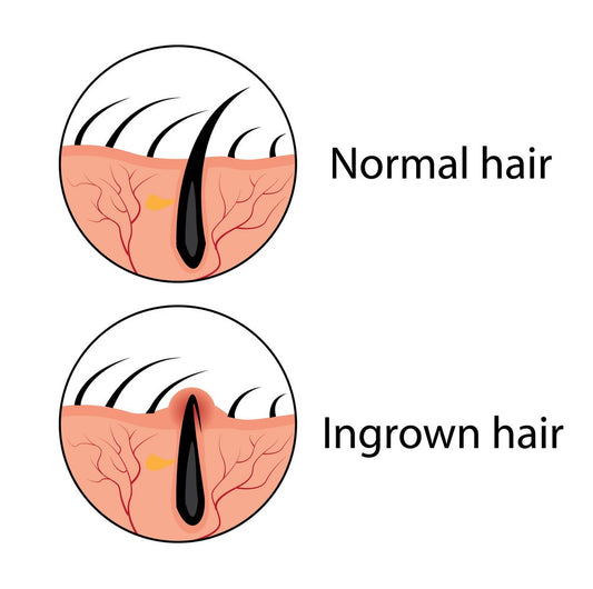 How To Treat Ingrown hairs: A step by step guide!